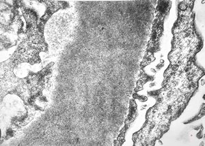 M,22y. | type II membranoproliferative glomerulonephritis
